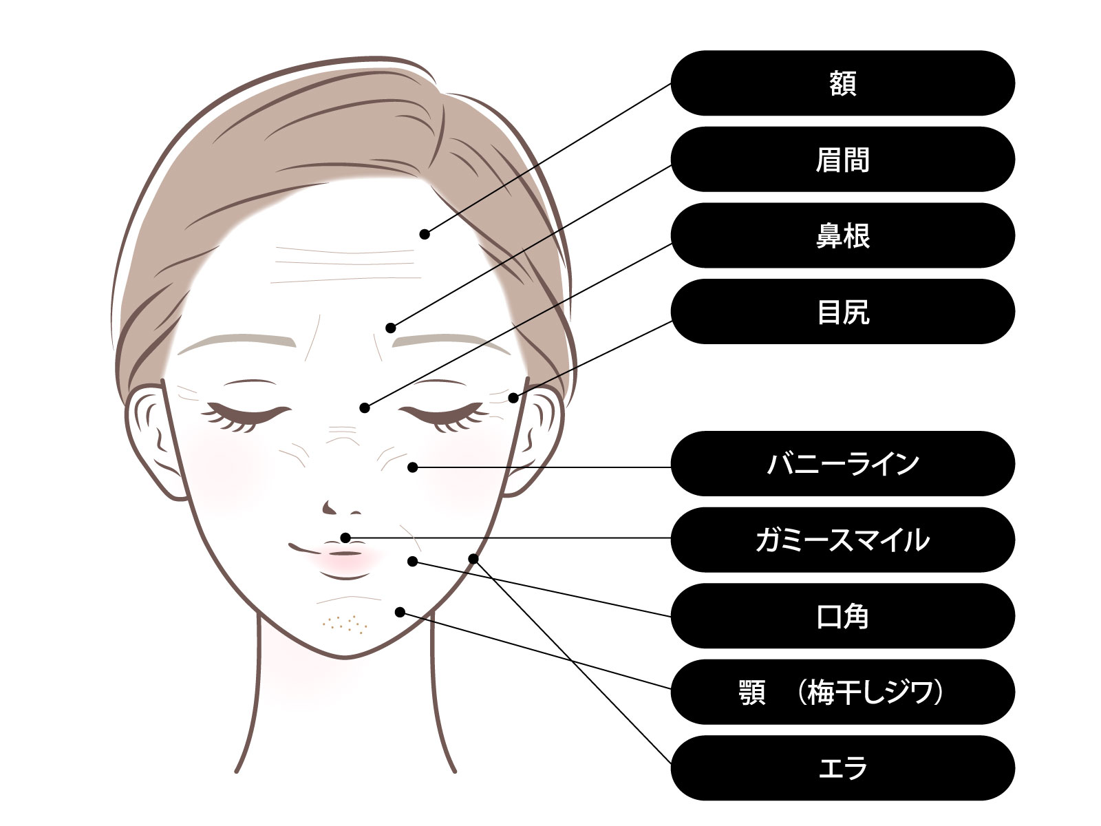 ボトックス注射可能部位